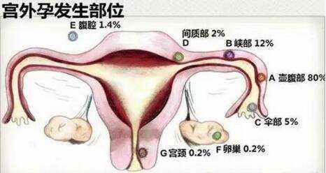 广州助孕哪家成功率高，广州试管婴儿成功几率高吗？